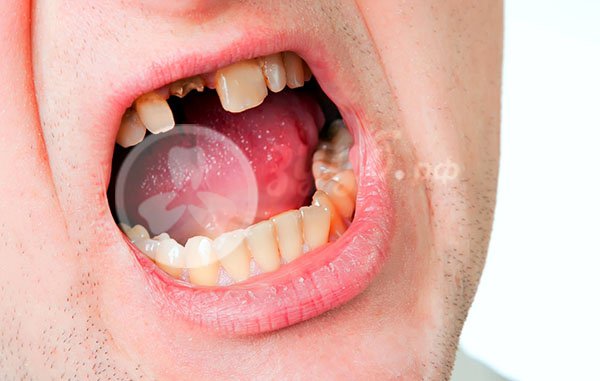 Лечение сломанного переднего зуба