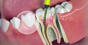 Что такое качественное лечение зубов