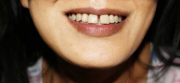 Щели между зубами исправление в стоматологии, промежутки между передними зубами.