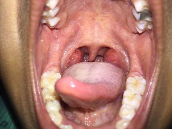 Воспаления в полости рта и их лечение