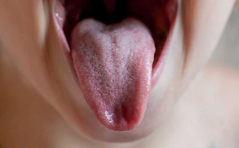 Симптомы кандидоза полости рта