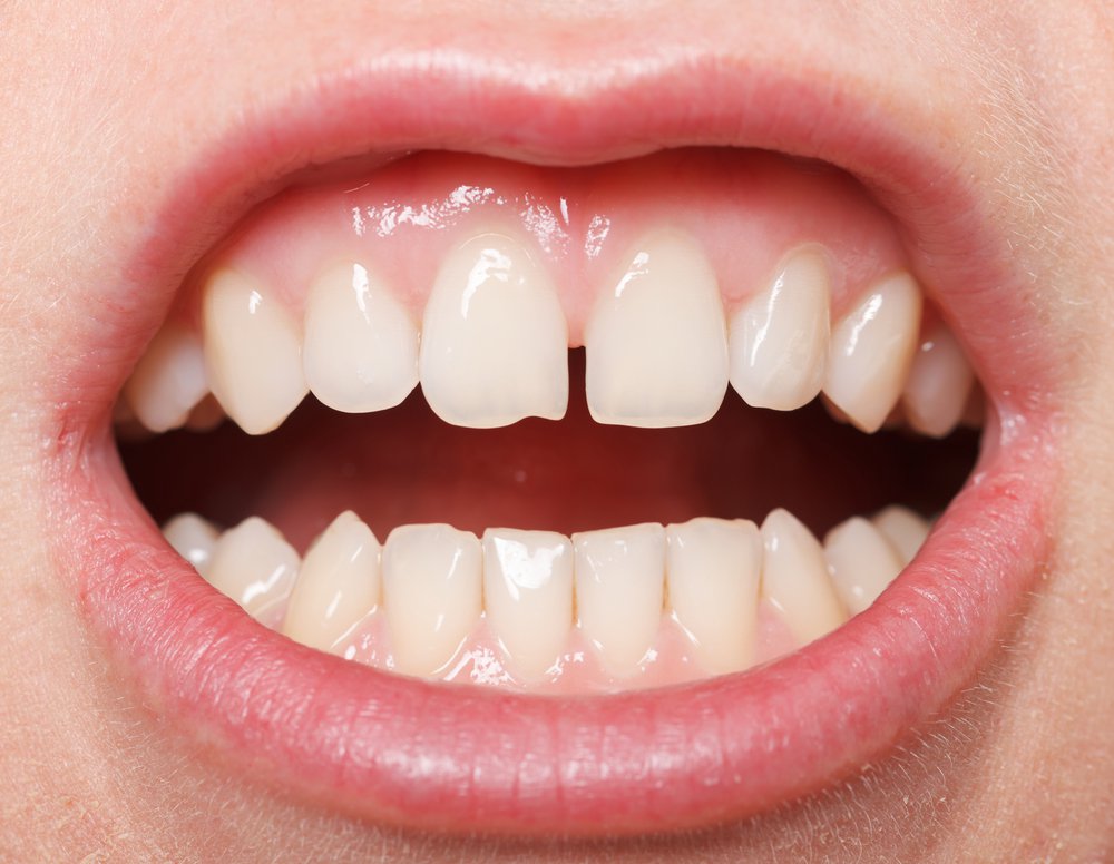 Современная стоматология предлагает несколько методов исправления дефекта – щели между передними зубами.