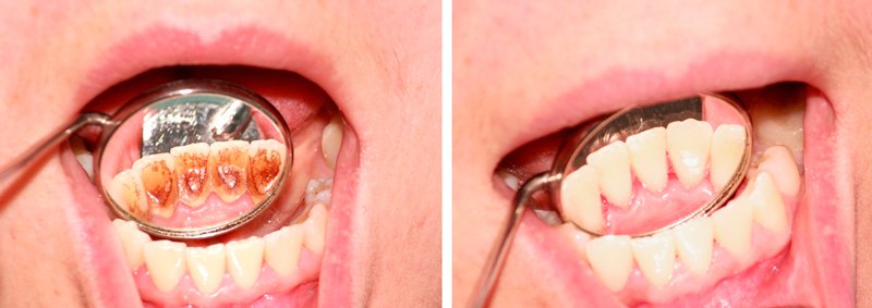 Фото зубов до профессиональной гигиенической чистки и после.