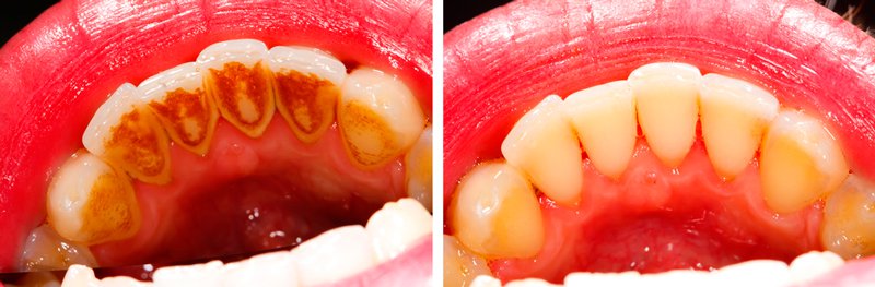Фото зубов до профессиональной гигиенической чистки и после.