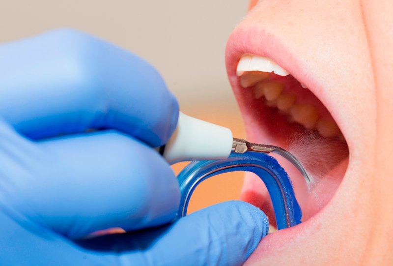 Пескоструйная технология профессиональной чистки зубов: воздействие на отложения под давлением струей специального состава.
