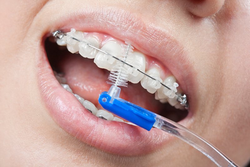 Гигиеническая чистка зубов за счет снятия мягкого и твердого налета осветляет зубы, достигая эффекта отбеливания.