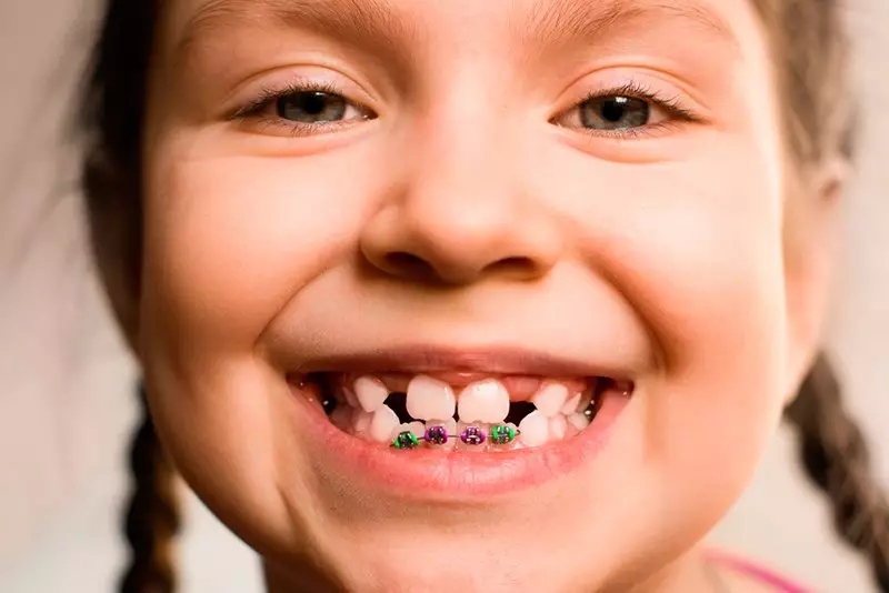 Детям обычно устанавливают самолигирующие брекеты с цветными резиночками.