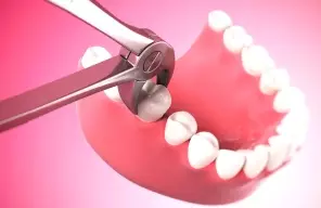 Удаление зуба перед имплантацией