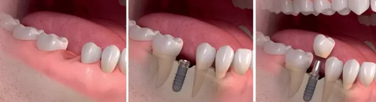 Этапы экспресс-имплантации зубов