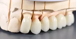 Коронки на задние зубы