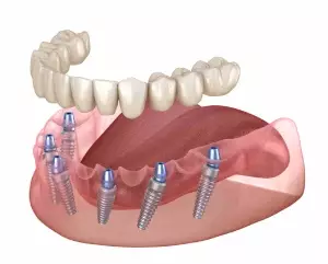 Имплантация нижних зубов по протоколу All-on-6