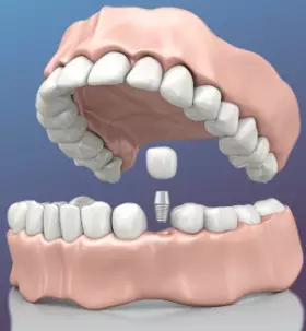 Имплантация зубов за 1 день