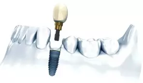 Имплантация зубов с немедленной нагрузкой