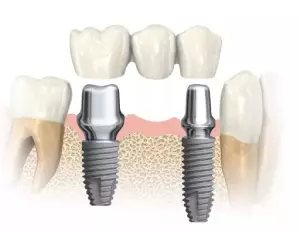 Преимущества имплантации зубов за 1 день