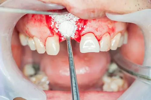 Виды материалов для костной пластики в стоматологии