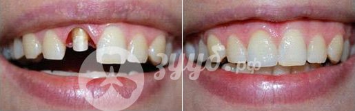 циркониевая коронка на поврежденный зуб до и после