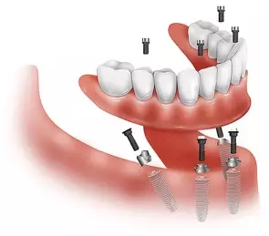 Имплантация зубов все-на-четырех