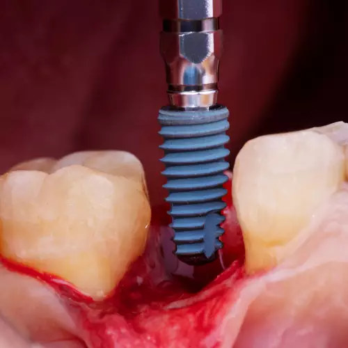 особенности зубных имплантов