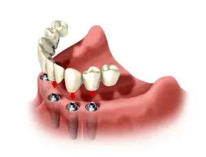 Имплантация нижних зубов по протоколу All-on-4