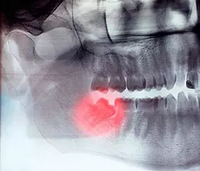 Дистопированный ретинированный зуб – такой зуб, который занимает неправильно положение в зубном ряду и не прорезался (или прорезался частично).