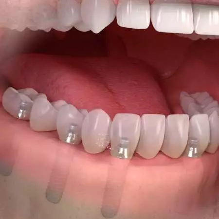 Виды имплантации зубов.