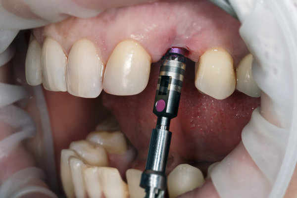 Осложнения после имплантации зубов. Часть 1. Доступная стоматология и имплантация