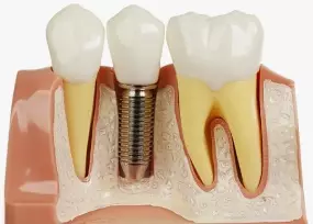 Имплантация зубов за один день