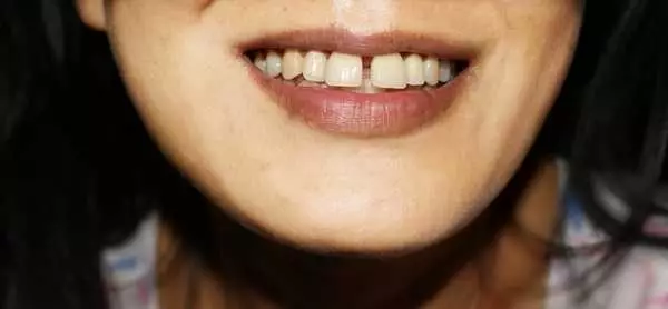 Расстояние между зубами