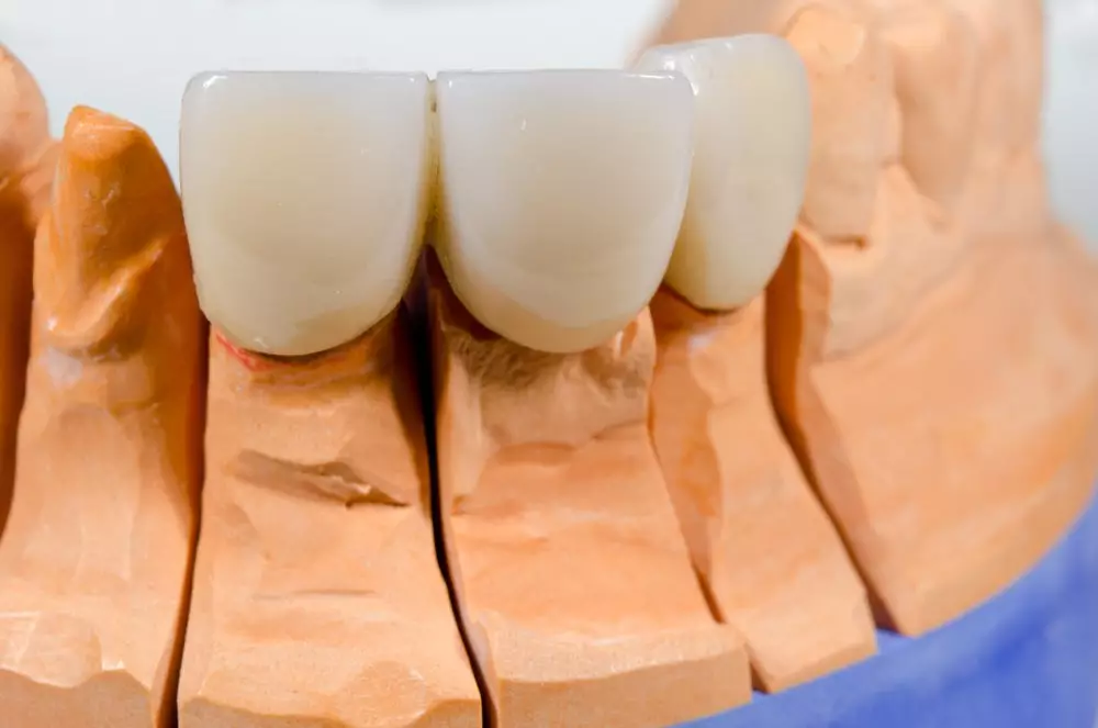 При отсутствии одного или двух зубов стоматологи предлагают установить либо зубной мост, либо импланты.