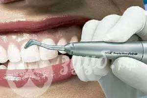 Чистка зубного камня на передних зубах