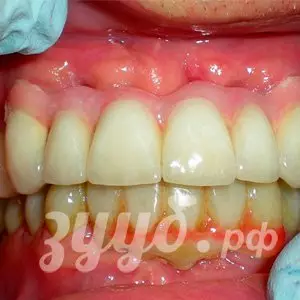 Протезирование при пародонтозе зубов
