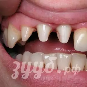 Шинирование подвижных зубов при пародонтозе