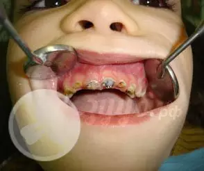 Множественный кариес молочных зубов