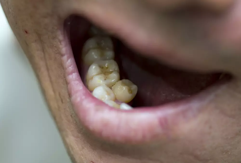 Удаление дистопированных зубов