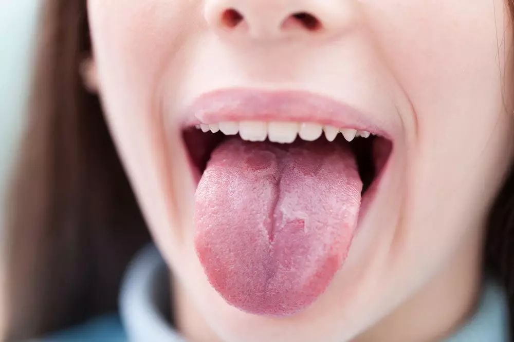 Глоссит – это воспаления языка.