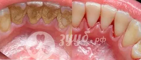 Устранение образований на зубах