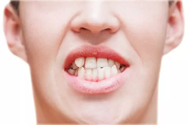 Ретенция зубов