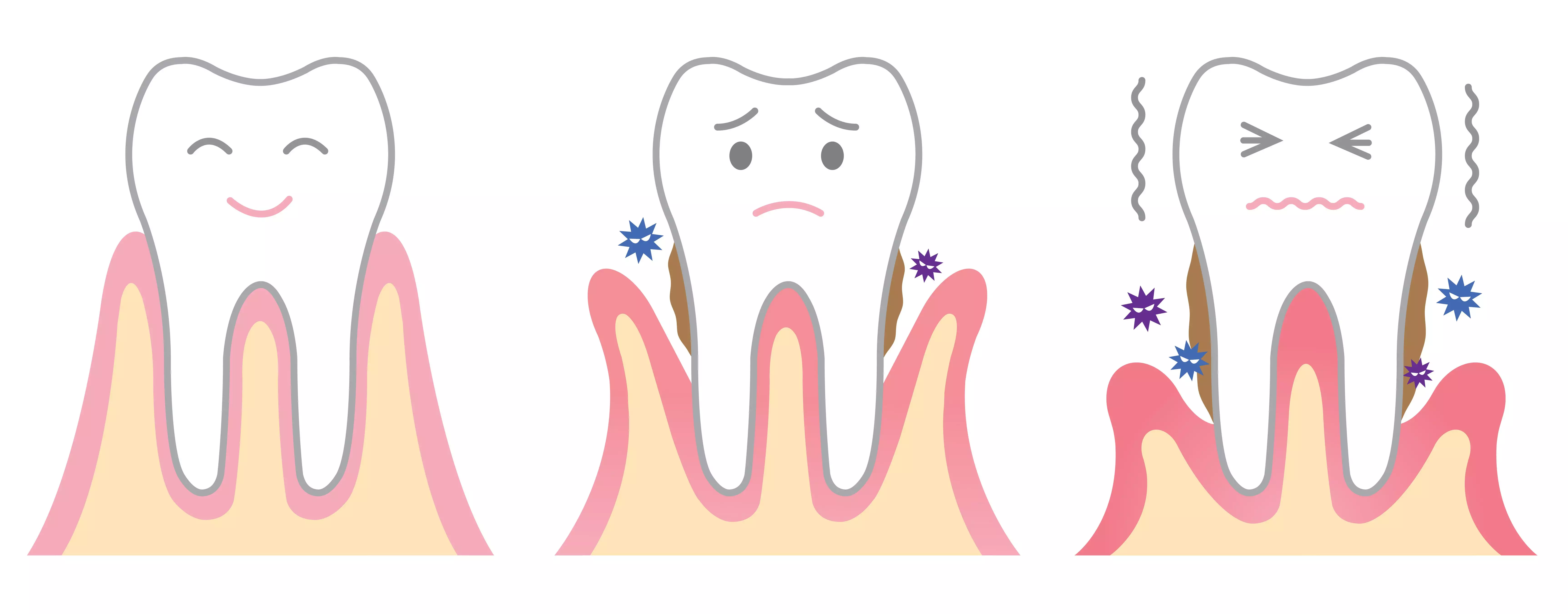 При пародонтозе разрушаются мягкие ткани около зуба. 