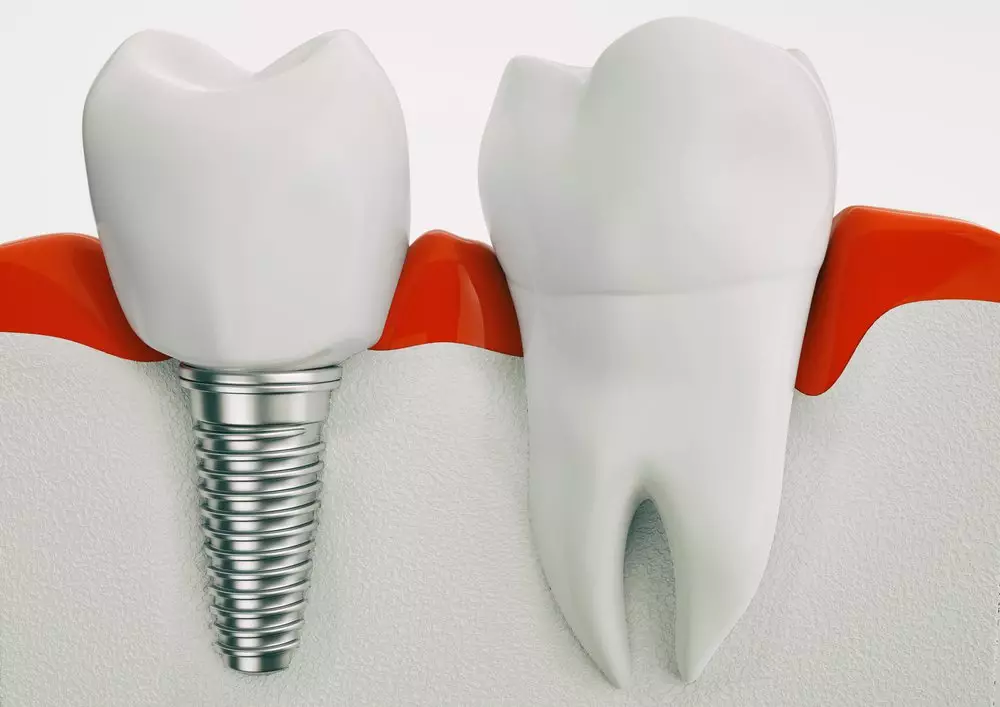 Имплантация – наиболее современный и совершенный способ восстановления целостности зубного ряда.