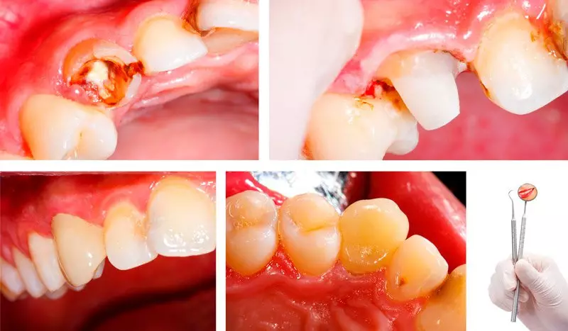 Циркониевые вкладки позволяют восстанавливать зубы до естественного вида даже при очень сильных разрушениях.